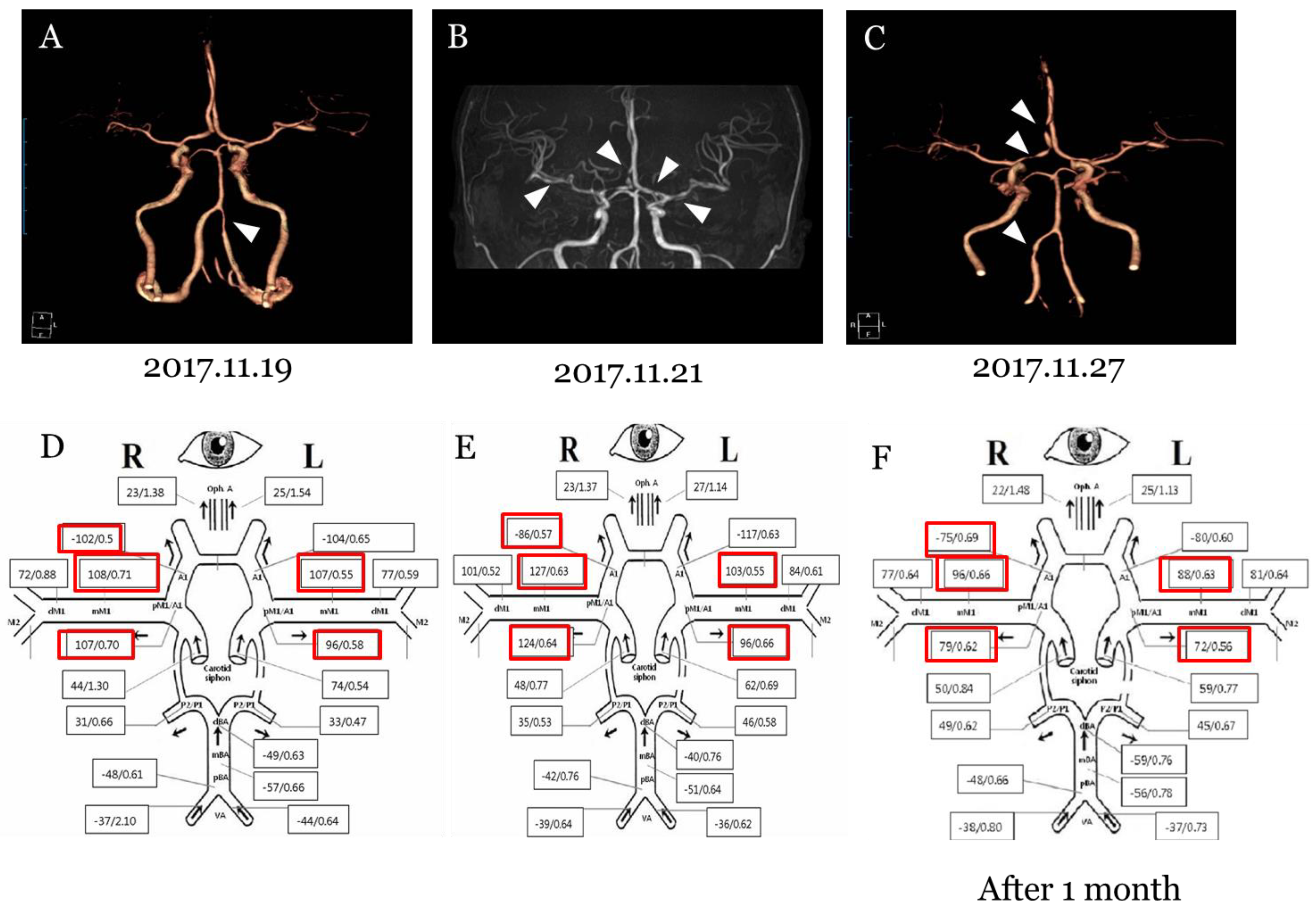 Reversible Cerebral Vasoconstriction Syndrome