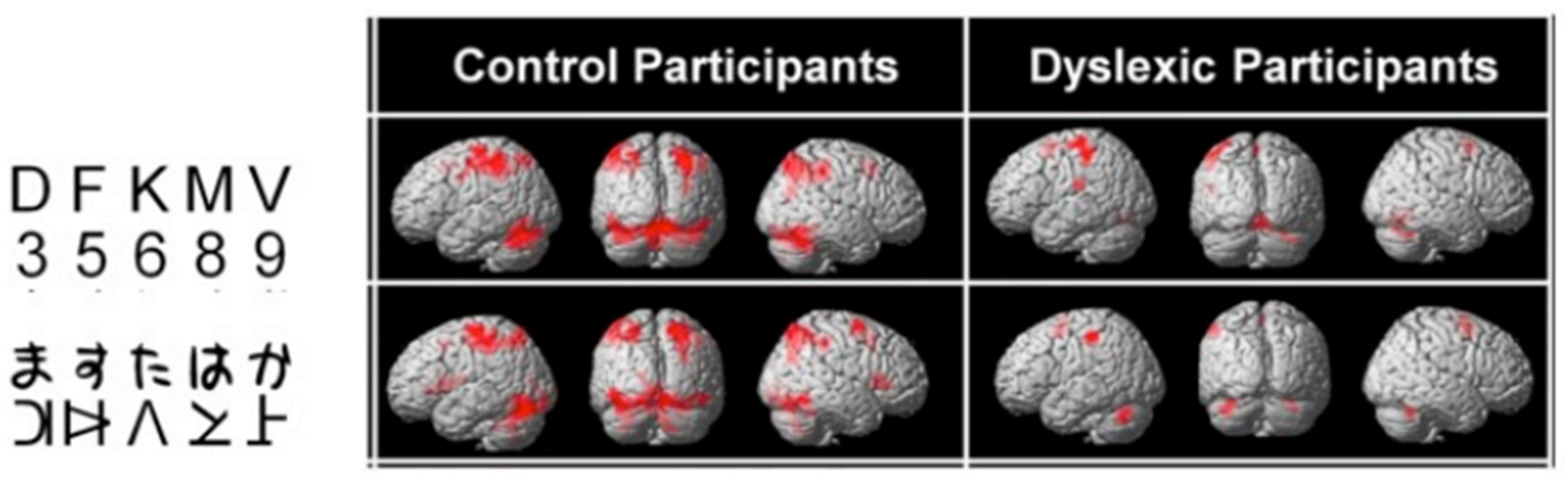 REVUE BRAIN Sciences • 27 Mai 2021 Dyslexie, la nouvelle donne par