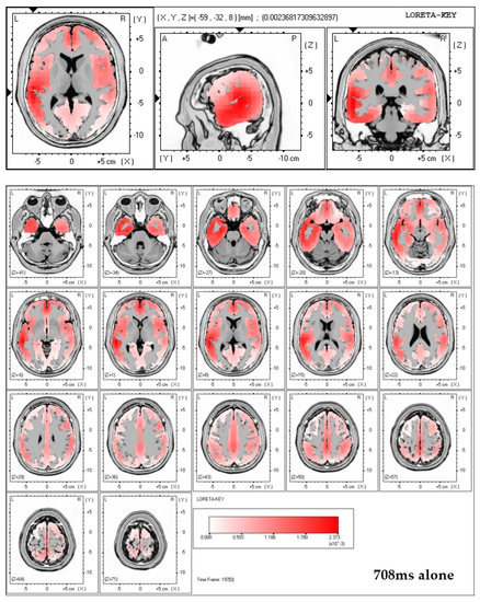 Electroencephalography (EEG) Reveals Increased Frontal Activity in