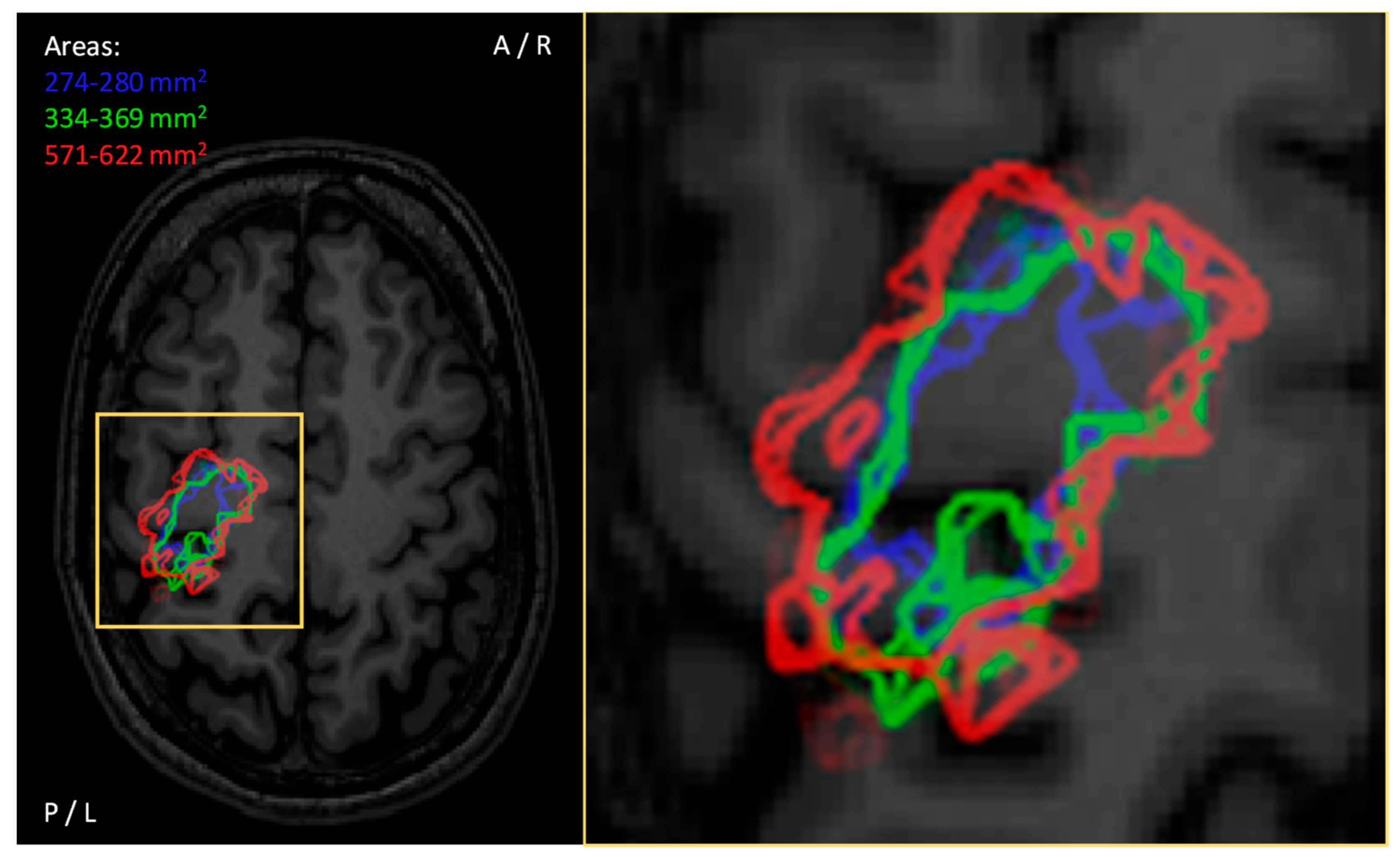brain mapping procedure tms brain mapping procedure tms