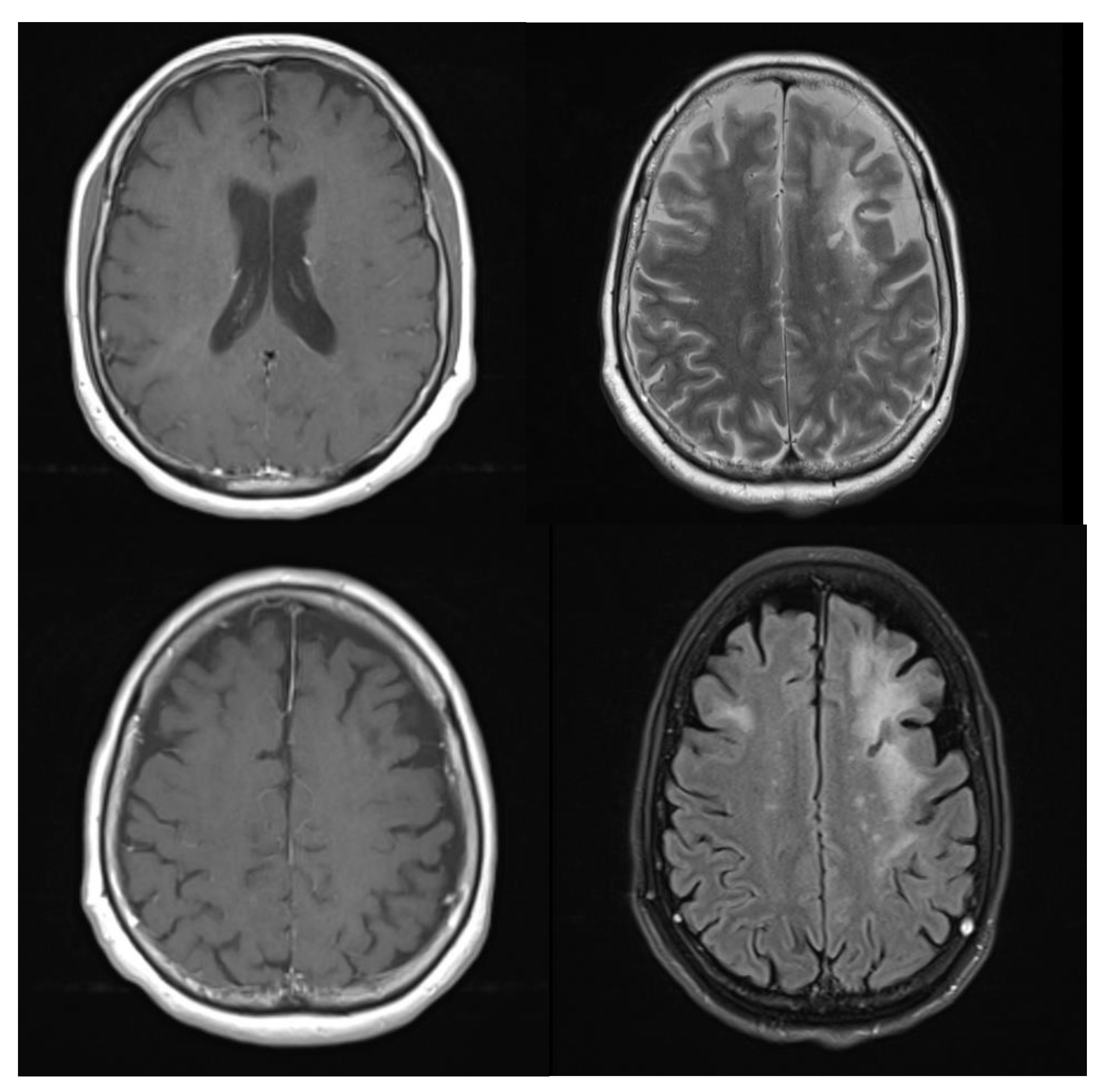 Brain Sciences | Free Full-Text | A Diagnostic Dilemma of White Matter