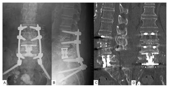 Minimally Invasive L5 Corpectomy with Navigated Expandable