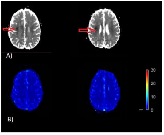 Optimal Scaling Approaches for Perfusion MRI with Distorted