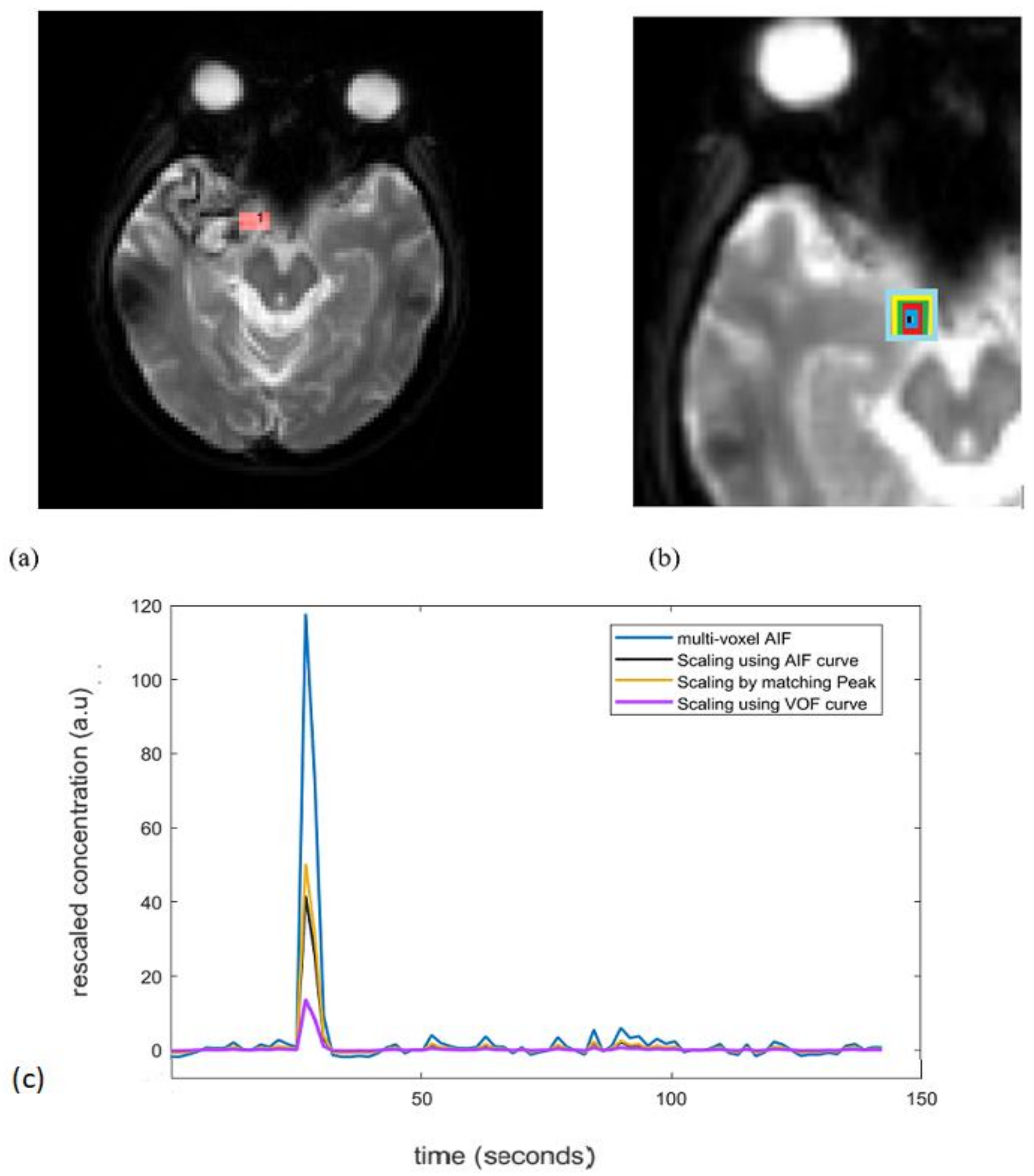 裁断済み　diffusion・perfusion MRI Frontiers | Diffusion–Perfusion Mismatch: An Opportunity for