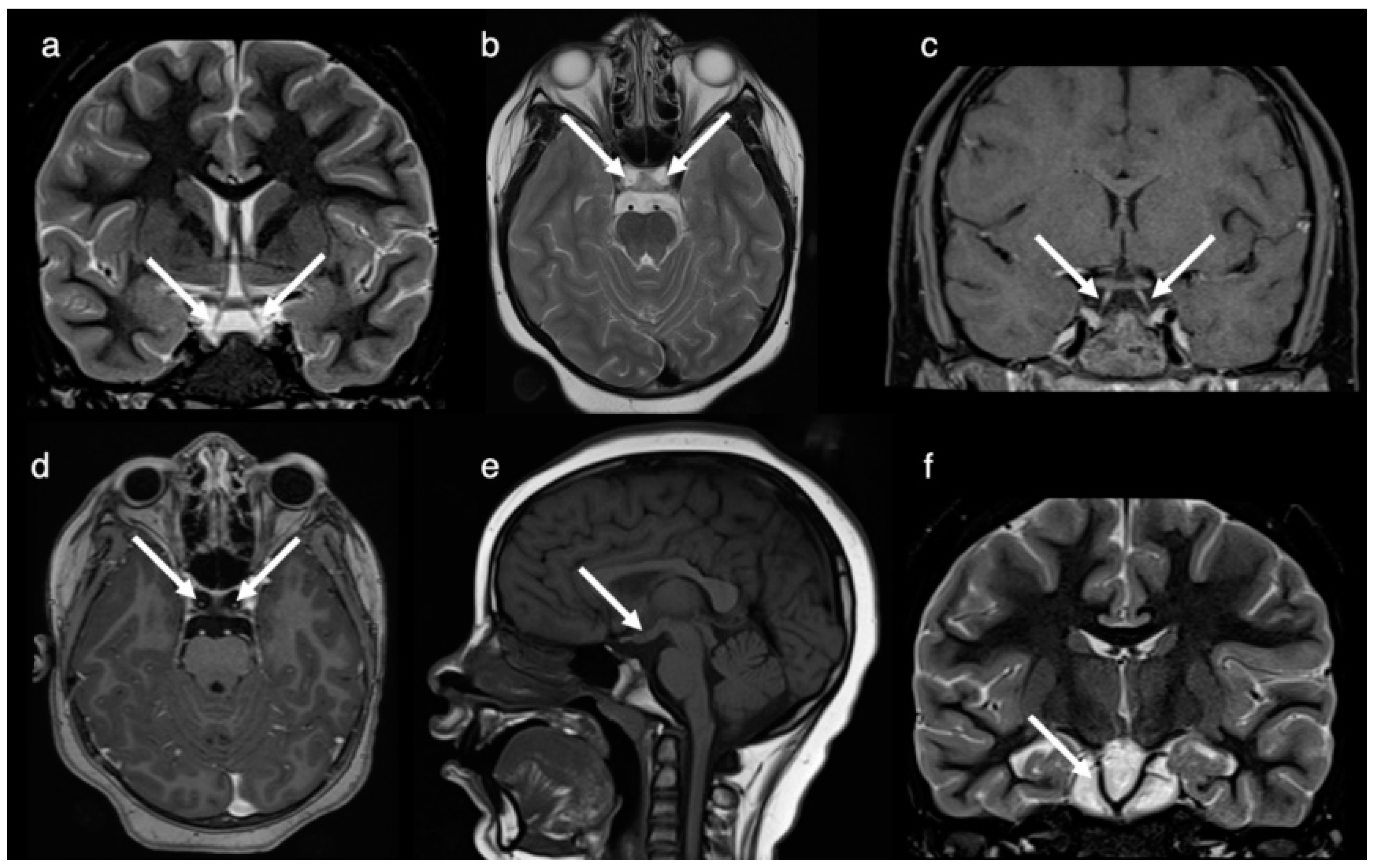 normal-pituitary-mri