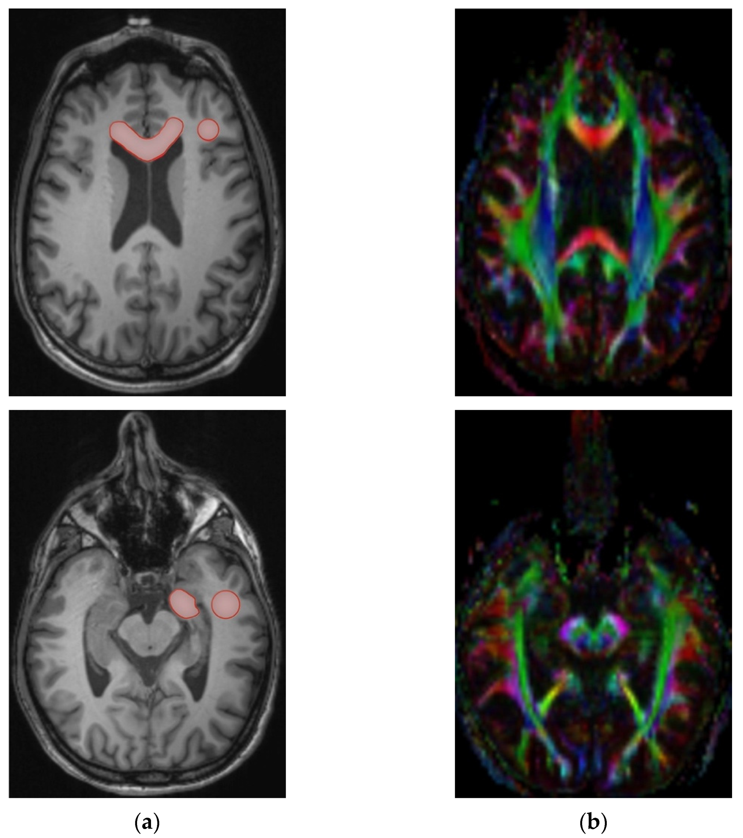 Brain Sciences | Free Full-Text | Effects of Hippocampal Sparing ...