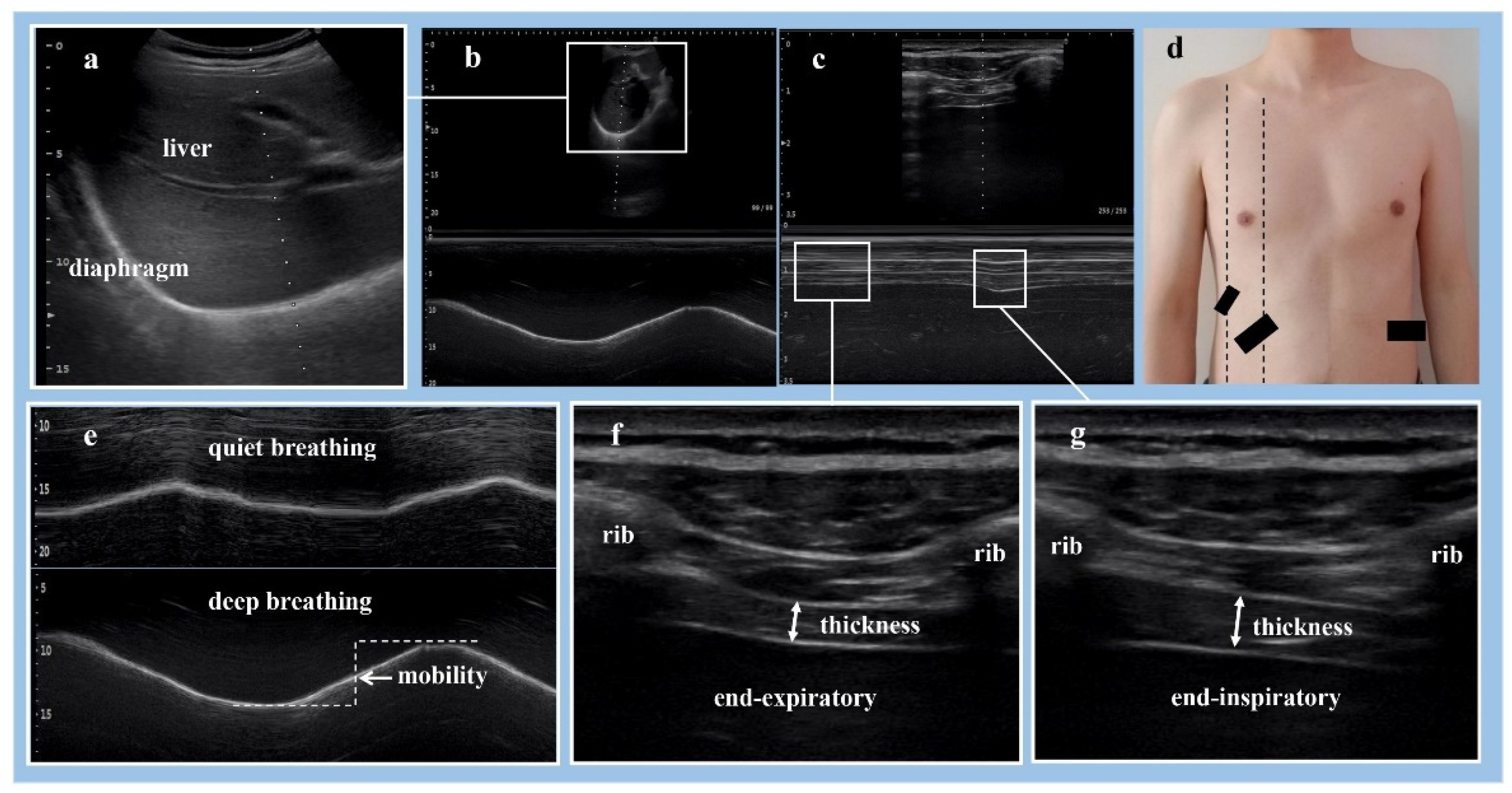 Brain Sciences Free FullText Assessment of Diaphragm in Hemiplegic