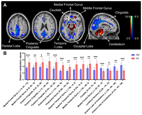 Brain Metabolic Connectivity Patterns in Patients with