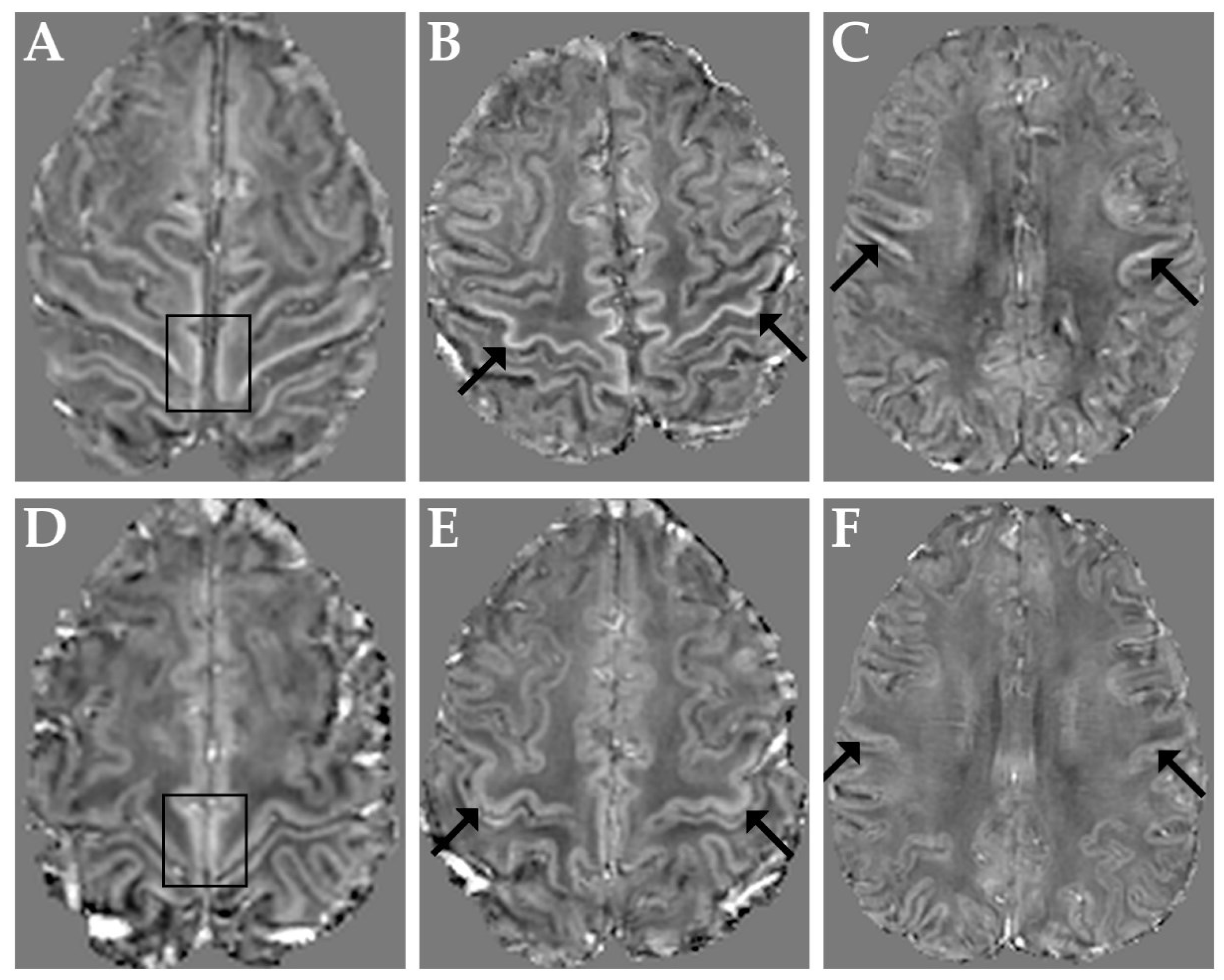 Brain Sciences | Free Full-Text | Distribution Indices of Magnetic  Susceptibility Values in the Primary Motor Cortex Enable to Classify  Patients with Amyotrophic Lateral Sclerosis