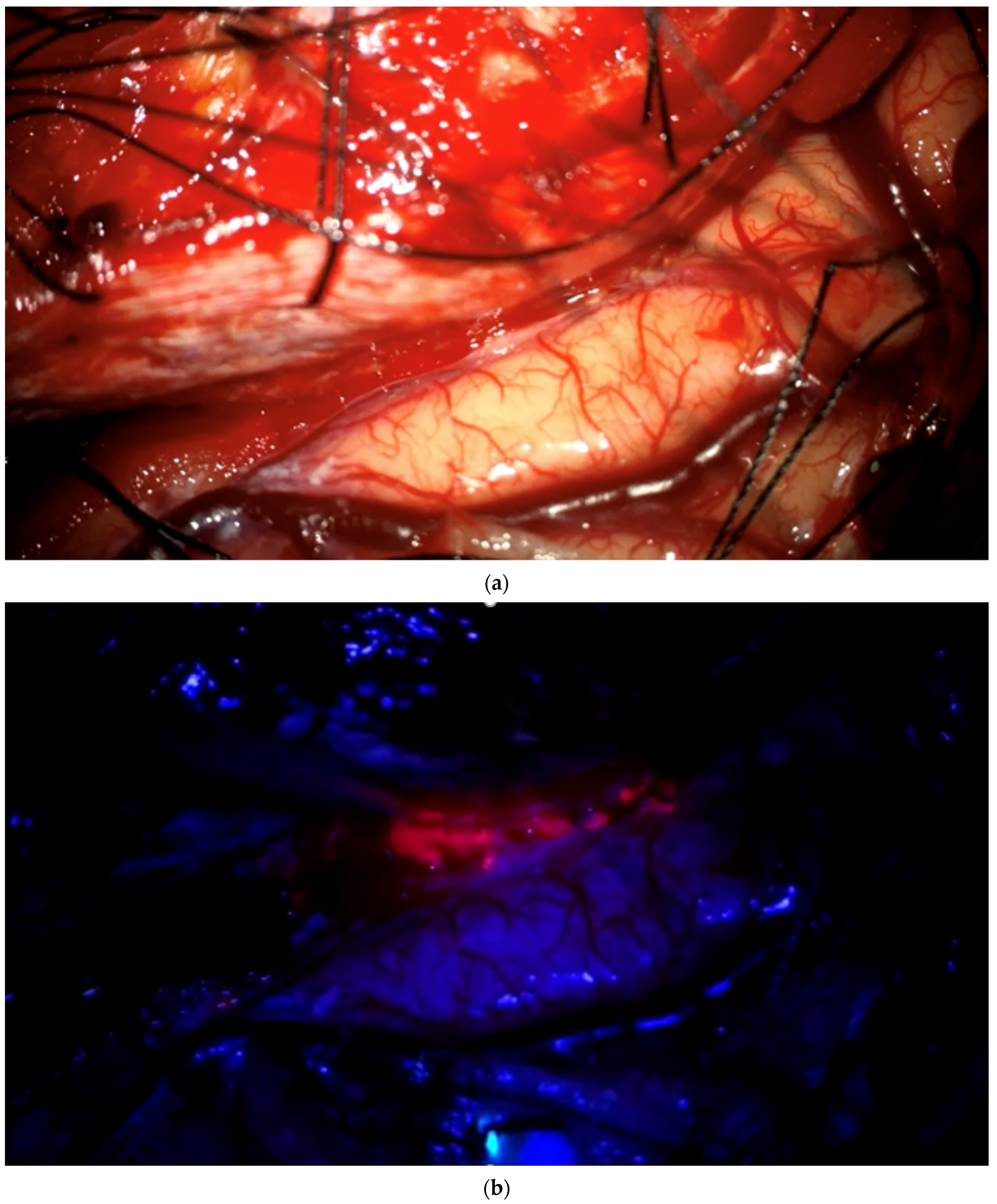 The NXDC-MEN-301 Study on 5-ALA for Meningiomas Surgery: An