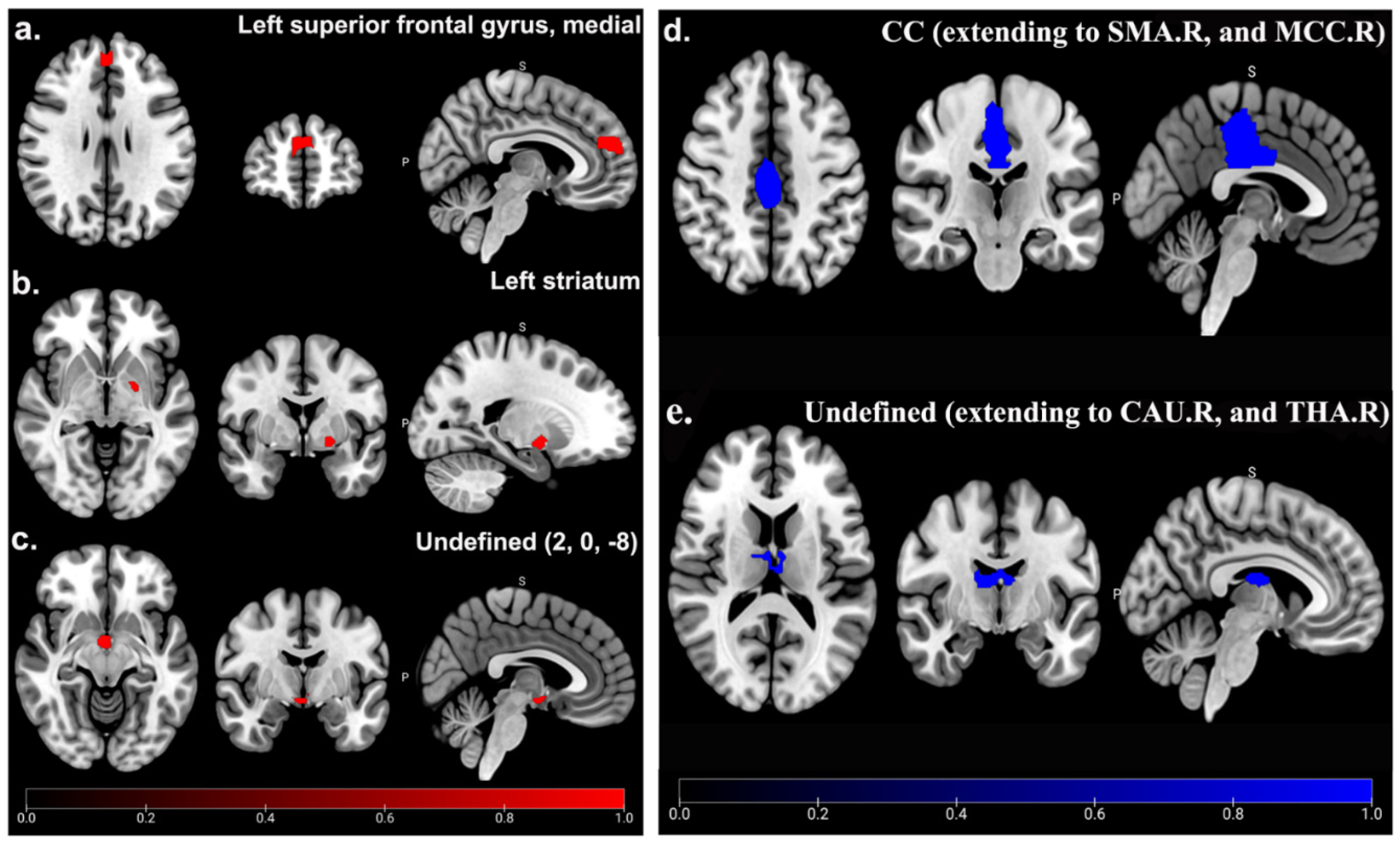 Gray Matter Abnormalities in Patients with Complex Regional