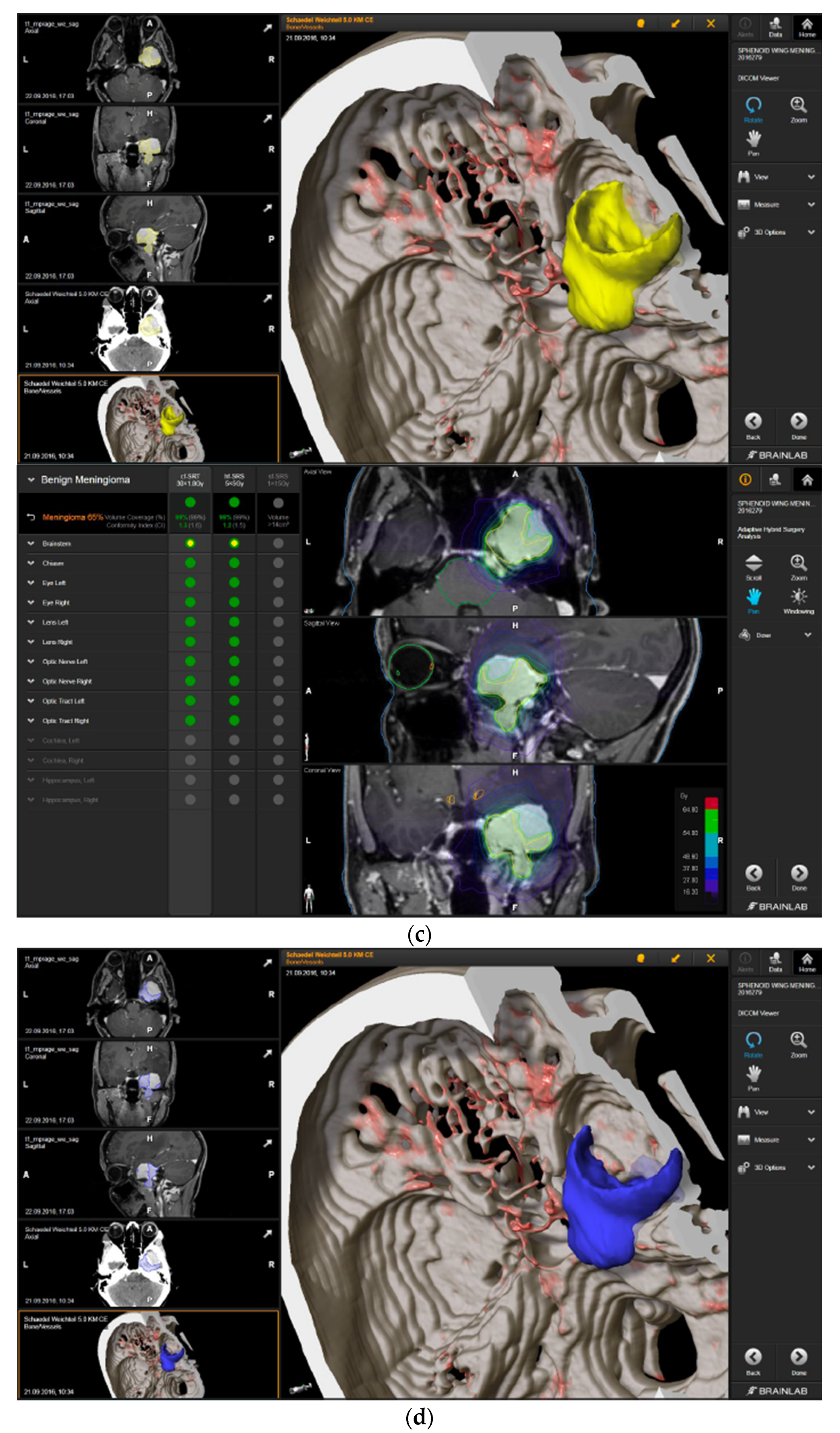 Brain Sciences | Free Full-Text | Adaptive Hybrid Surgery Experiences in  Benign Skull Base Tumors
