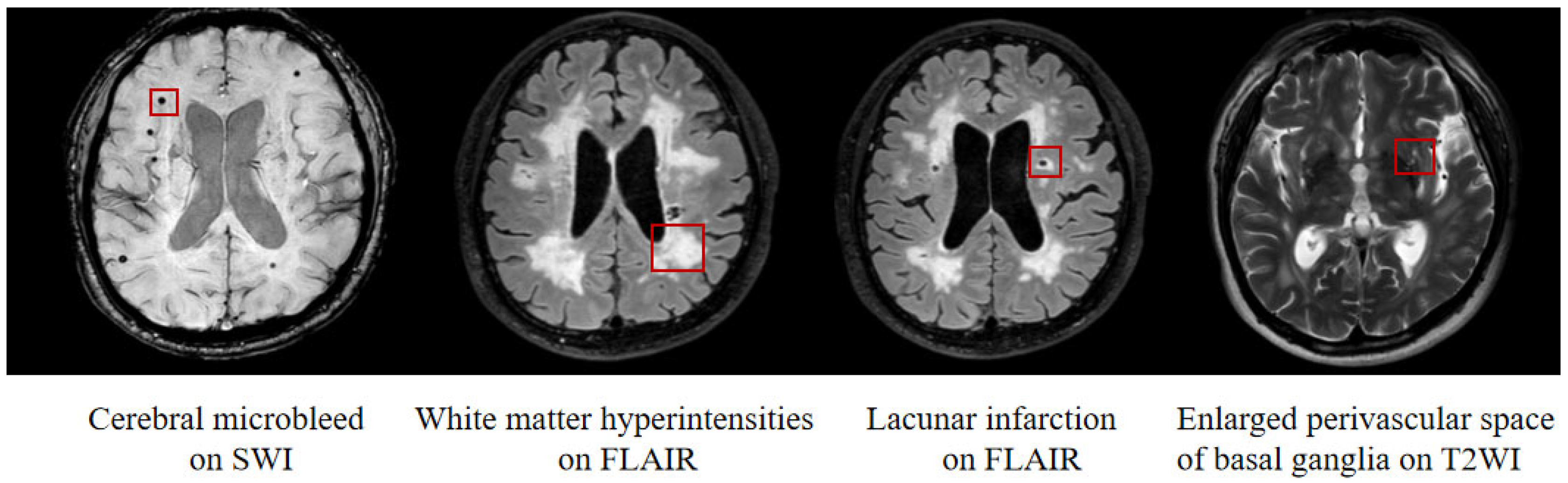 Brain Sciences | Free Full-Text | Glymphatic Dysfunction Mediates the