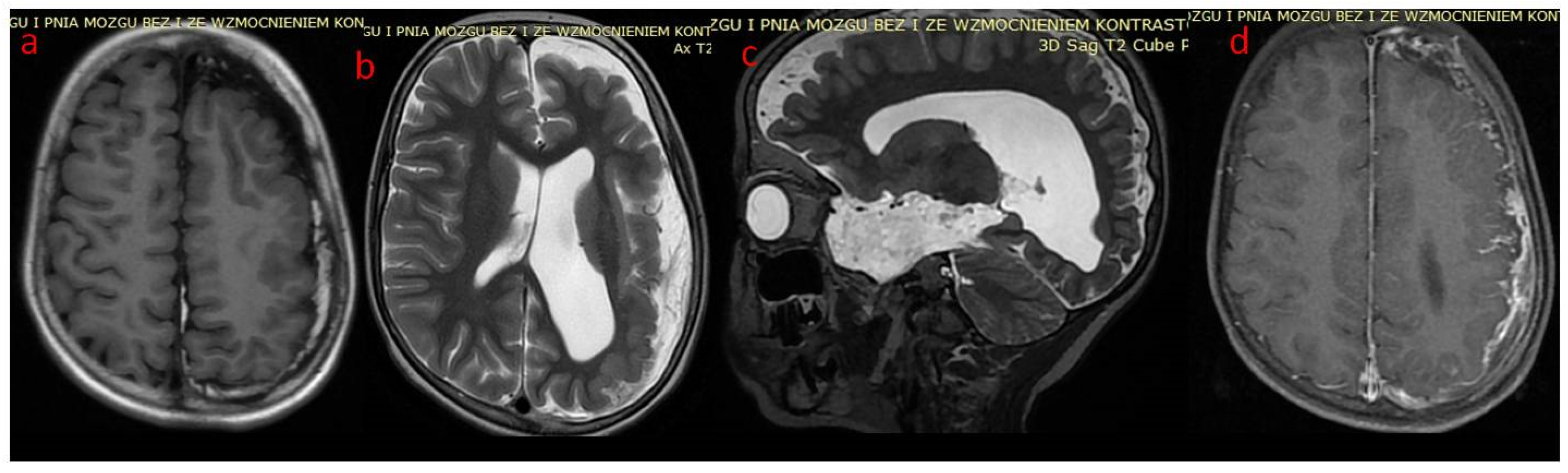 Brain Sciences Free FullText Encephalocraniocutaneous Lipomatosis