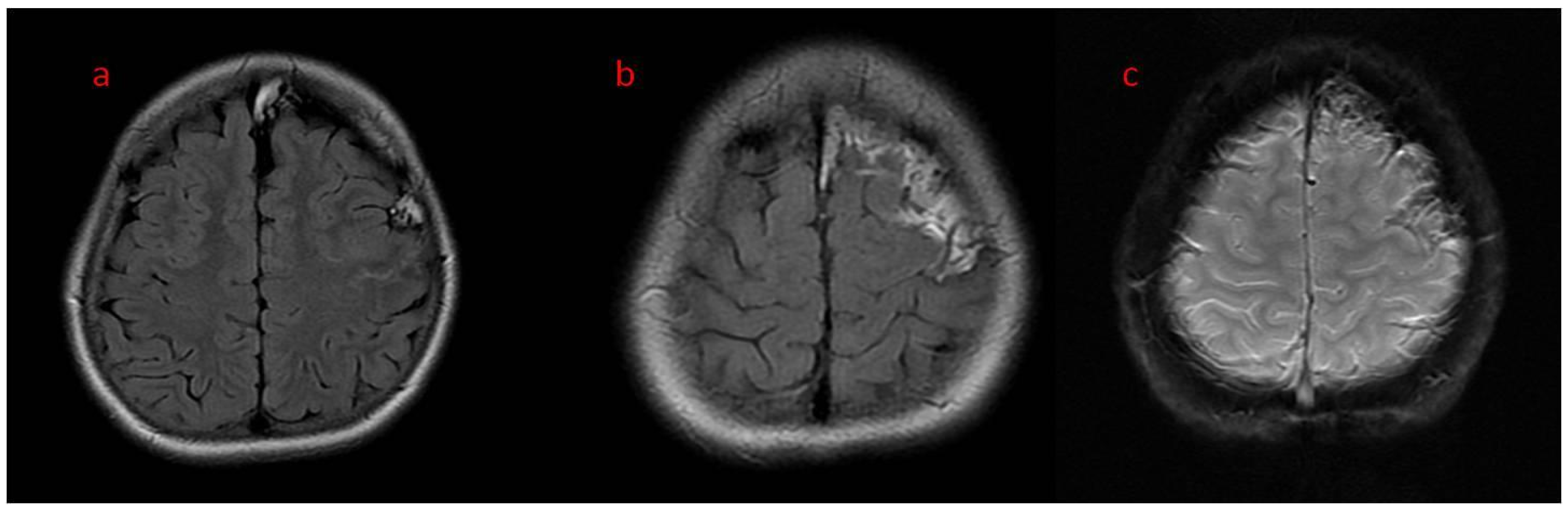Brain Sciences Free FullText Encephalocraniocutaneous Lipomatosis