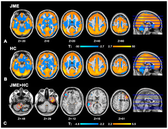 Altered Cerebro-Cerebellar Effective Connectivity in New