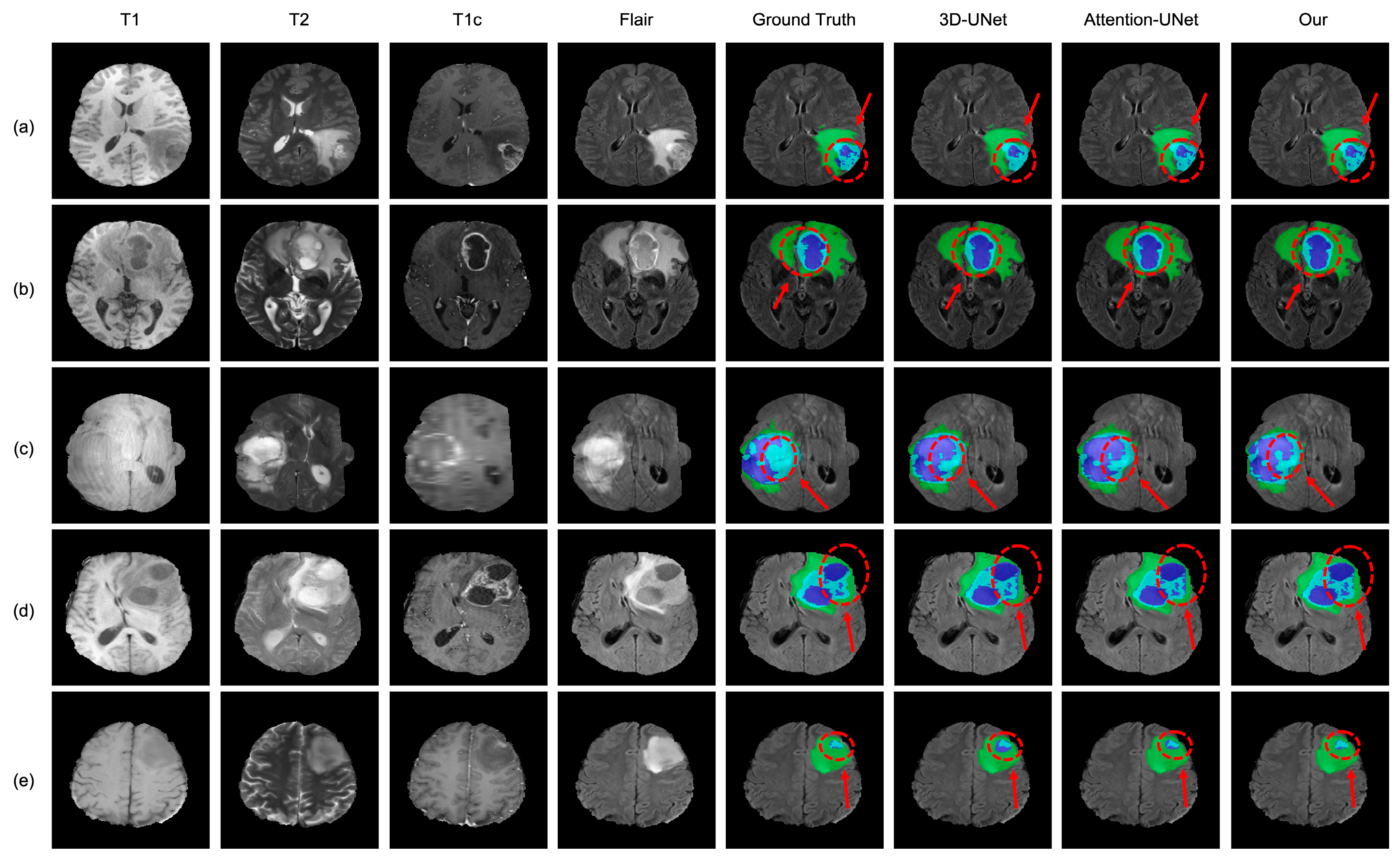 Brain tumor segmentation based on deep learning and an attention mechanism  using MRI multi-modalities brain images