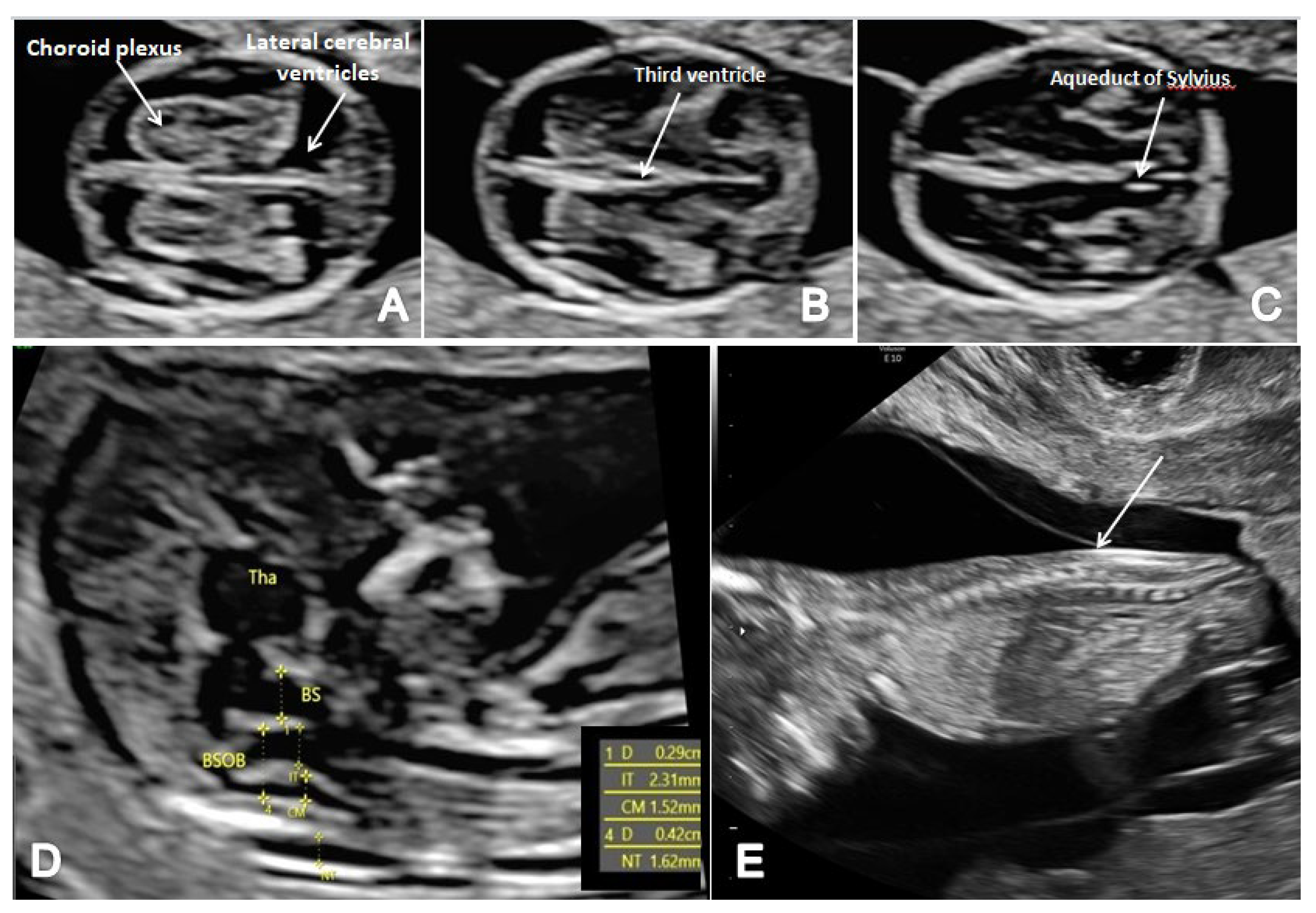 Brain Sciences Free Full Text First Trimester Ultrasound Detection