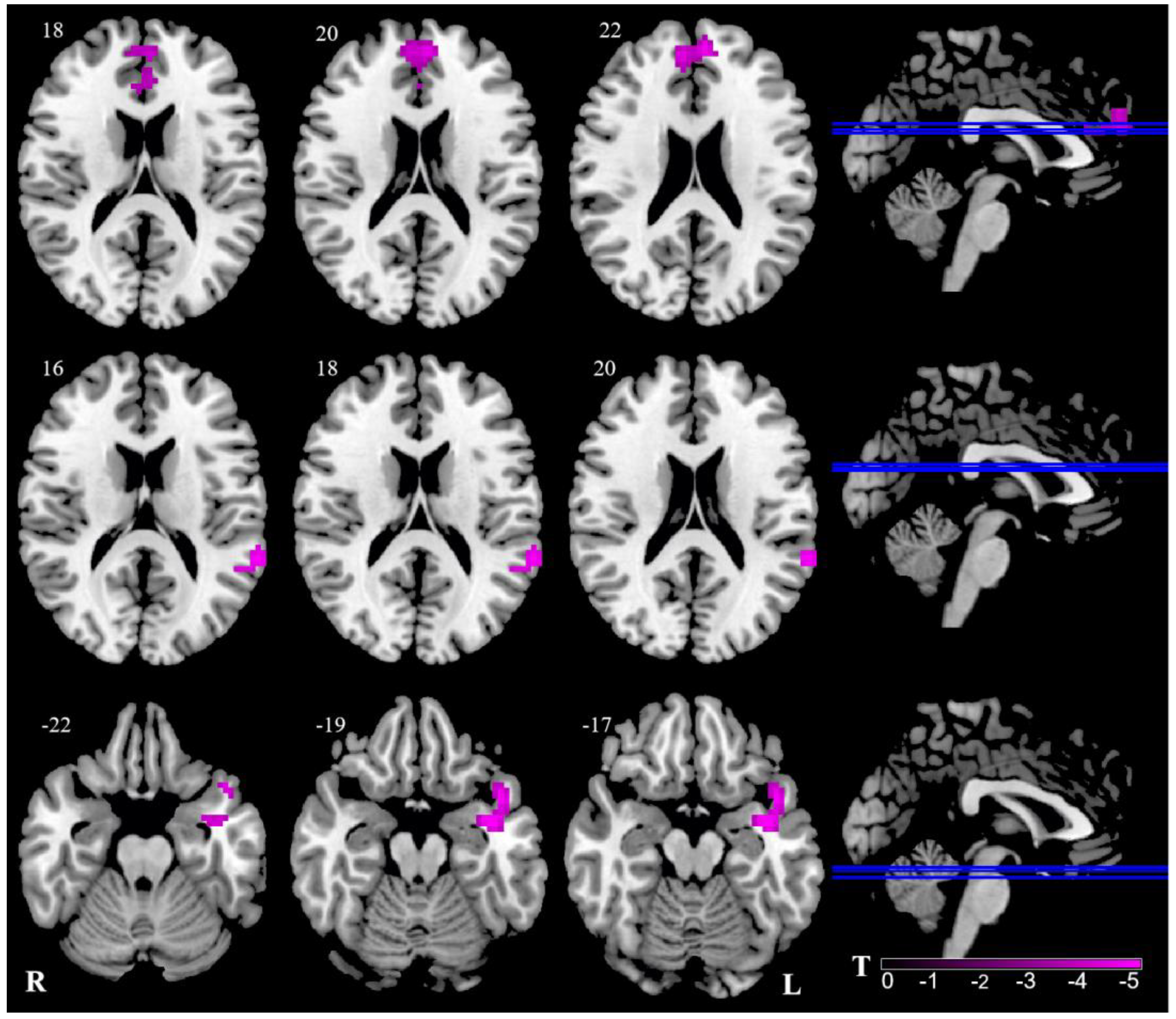 【SURGERY】Process 027 Surgical Neurology International