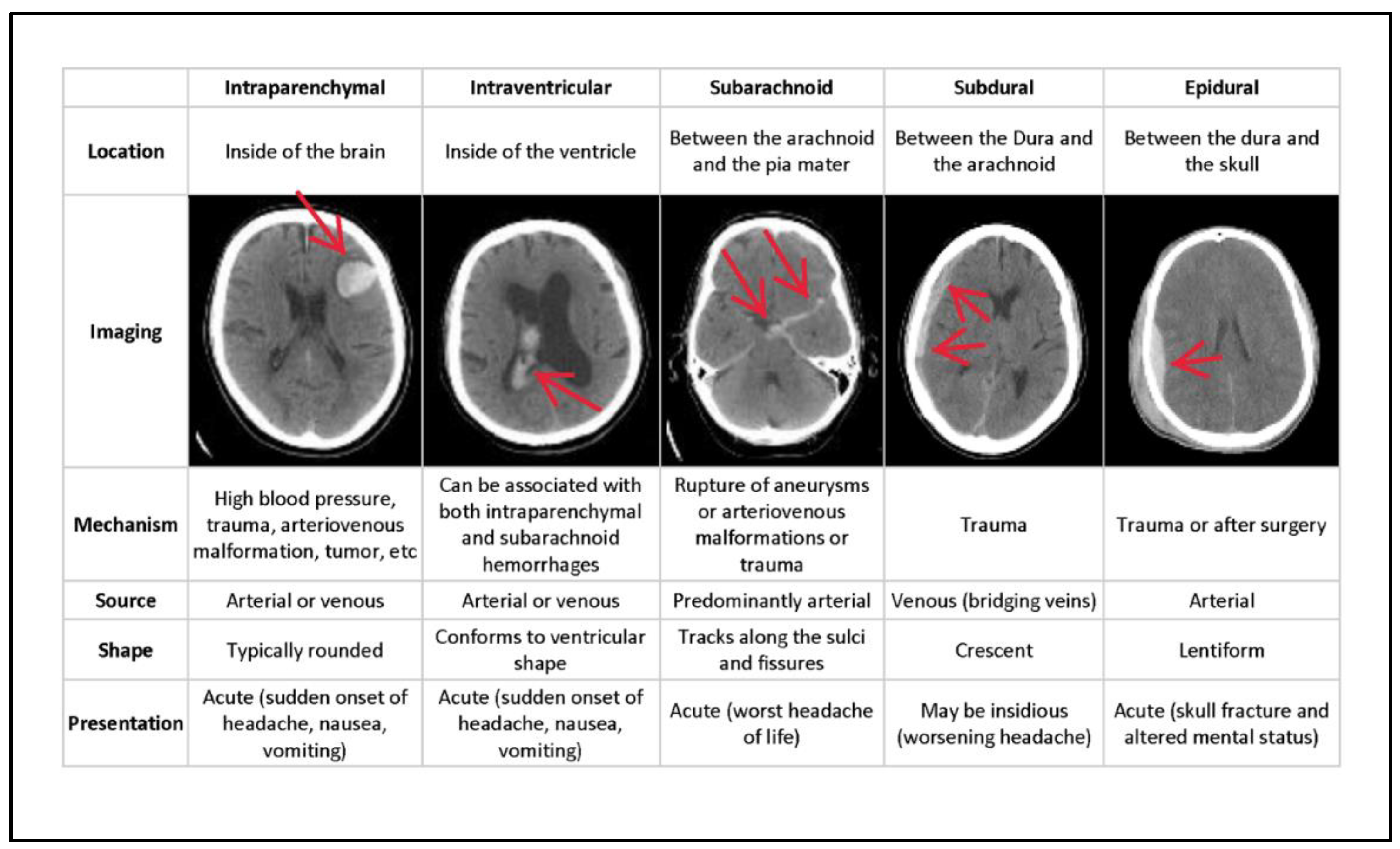 Subarachnoid Hemorrhage - What You Need to Know