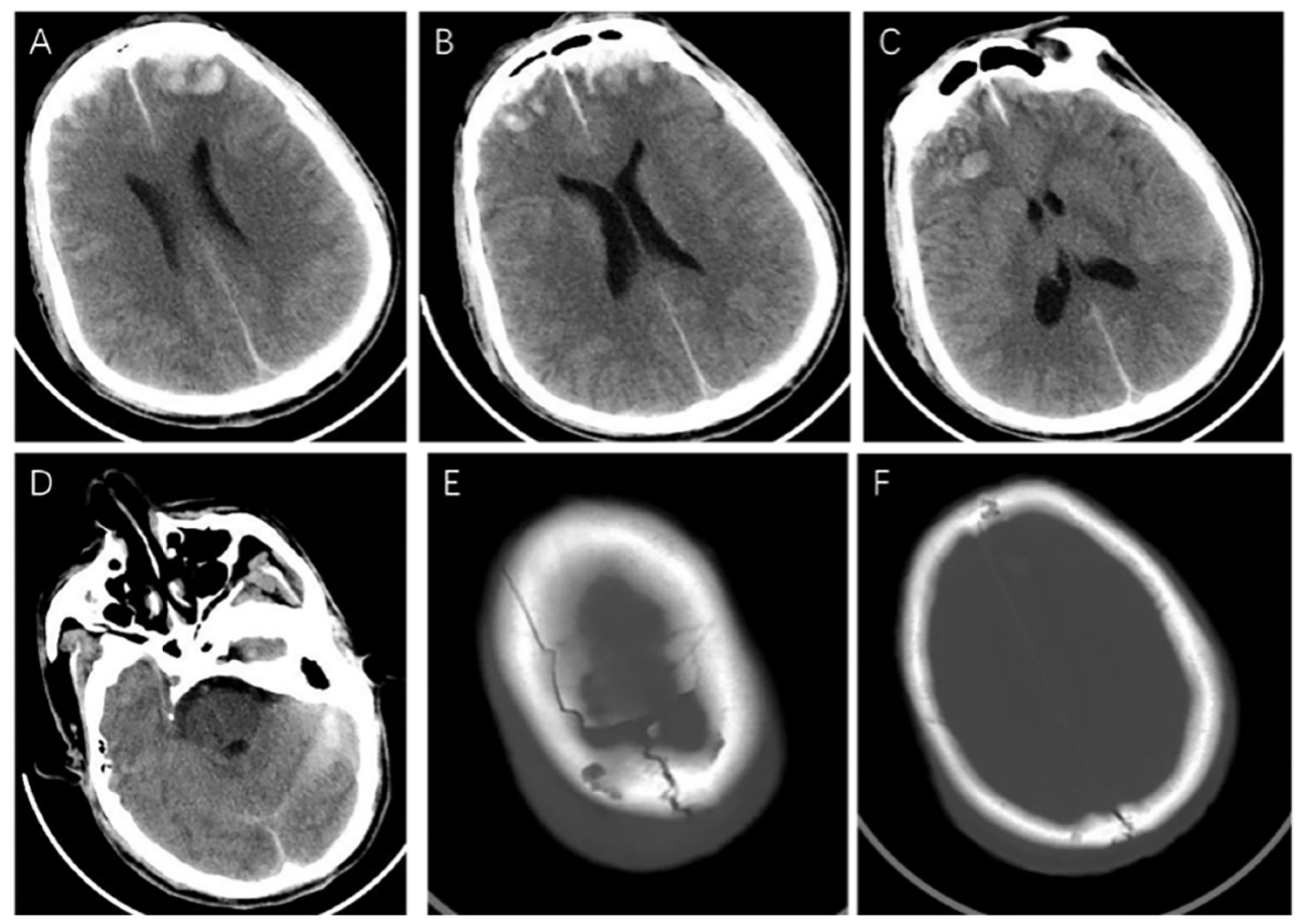 Guillain Barre Syndrome Hesi Case Study - 34iop3m