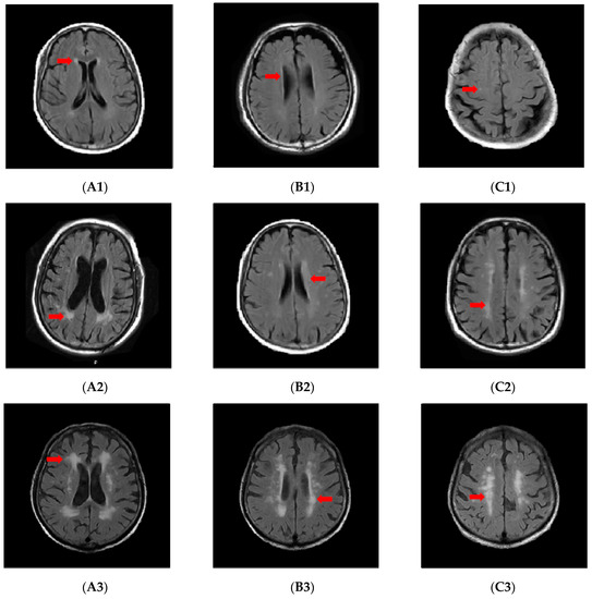 健康・医学 HOMEOPATHY FOR ANGER AND MORTIFICATION Analysis of Risk Factors for White Matter Hyperintensity in