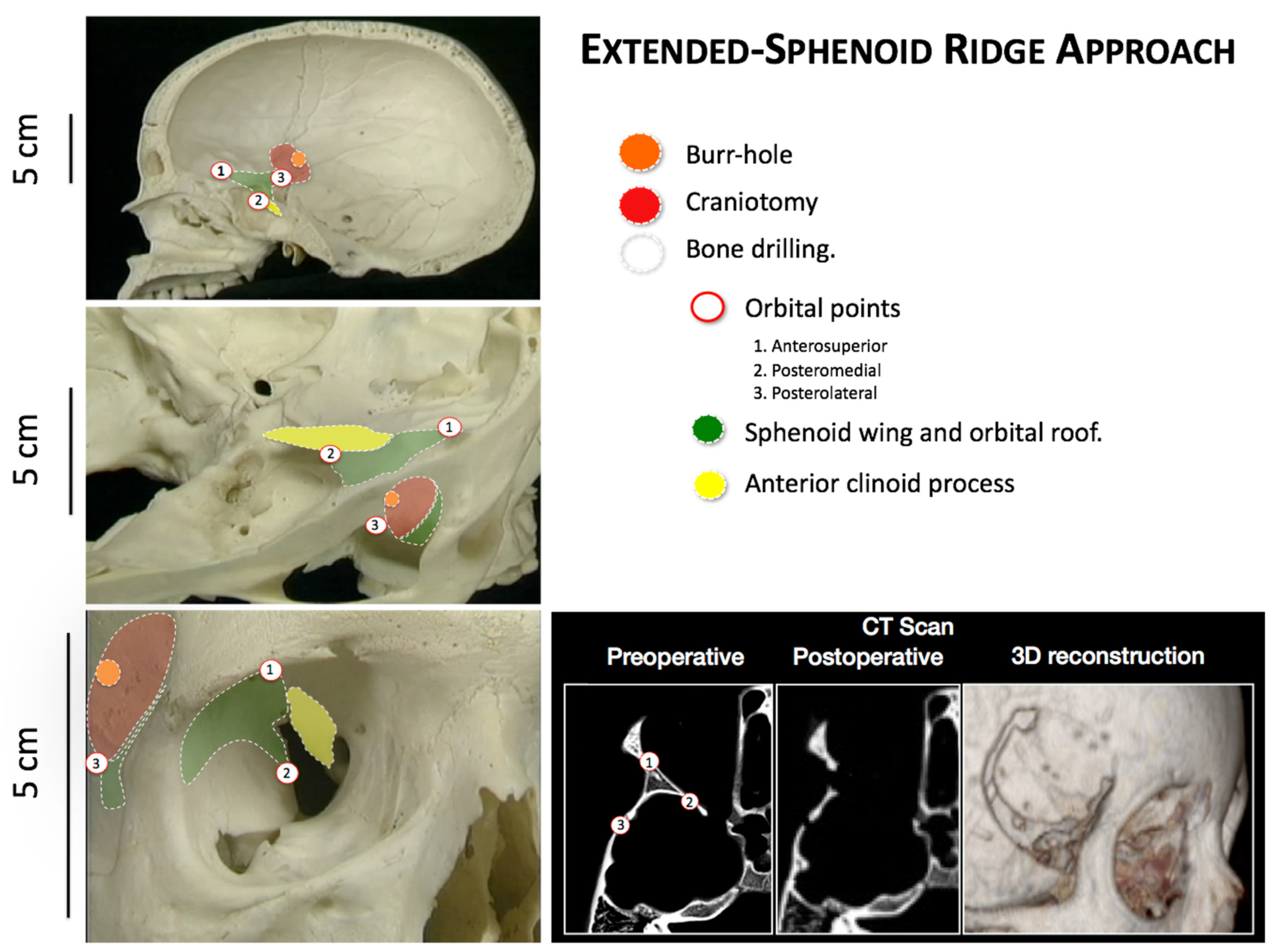 Brain Sciences Free Full Text The Extended Sphenoid Ridge