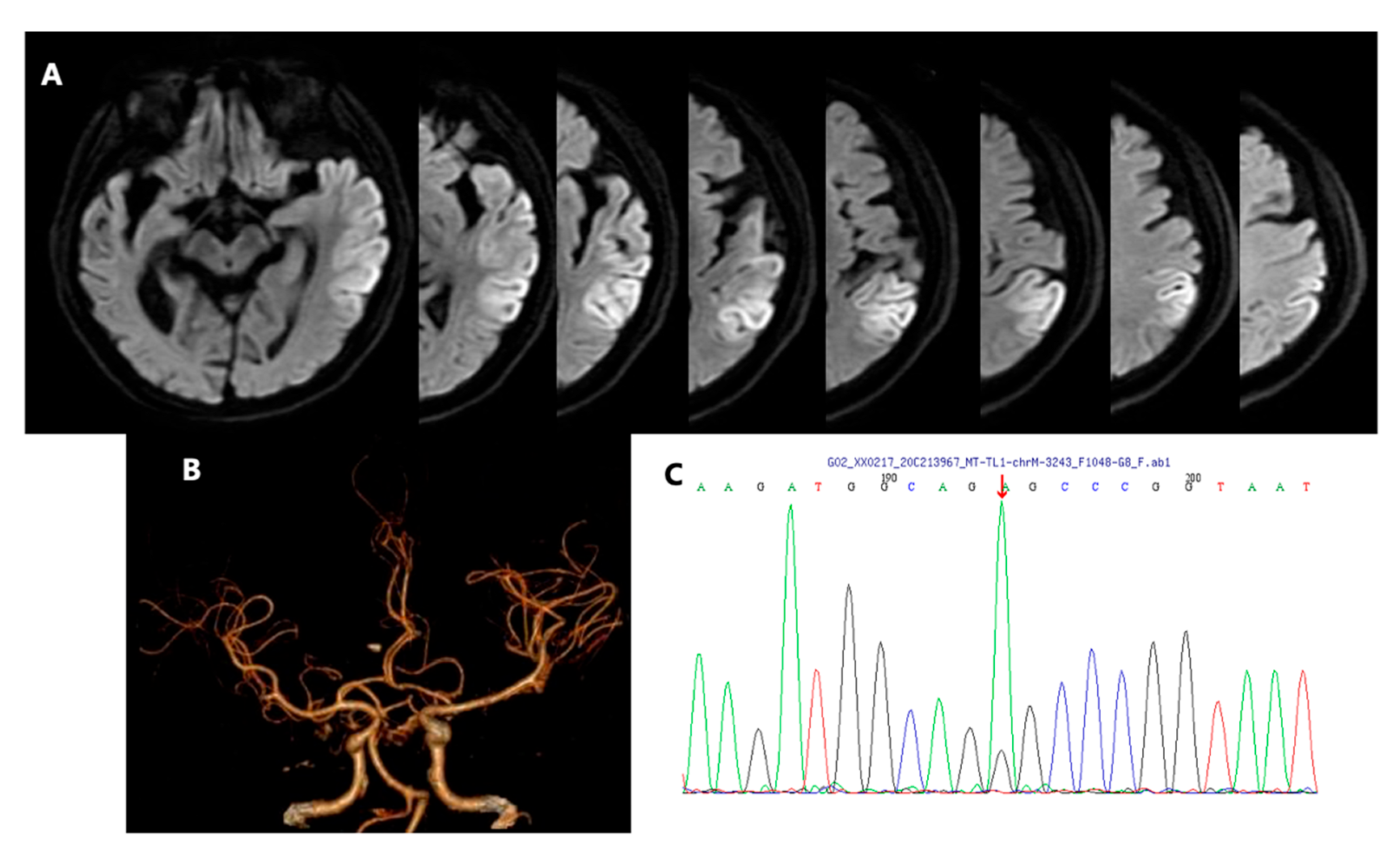 Brain Sciences Free Full-Text Refractory Hypotension in a Late-Onset Mitochondrial Encephalomyopathy, Lactic Acidosis, and Stroke-like Episodes (MELAS) Male with m.3243 Aandgt;G Mutation A Case Report