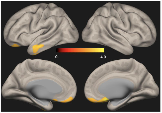 Depression Is Associated with the Aberration of Resting State Default ...