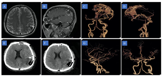 Microsurgical Treatment of Arteriovenous Malformations: A Single-Center ...