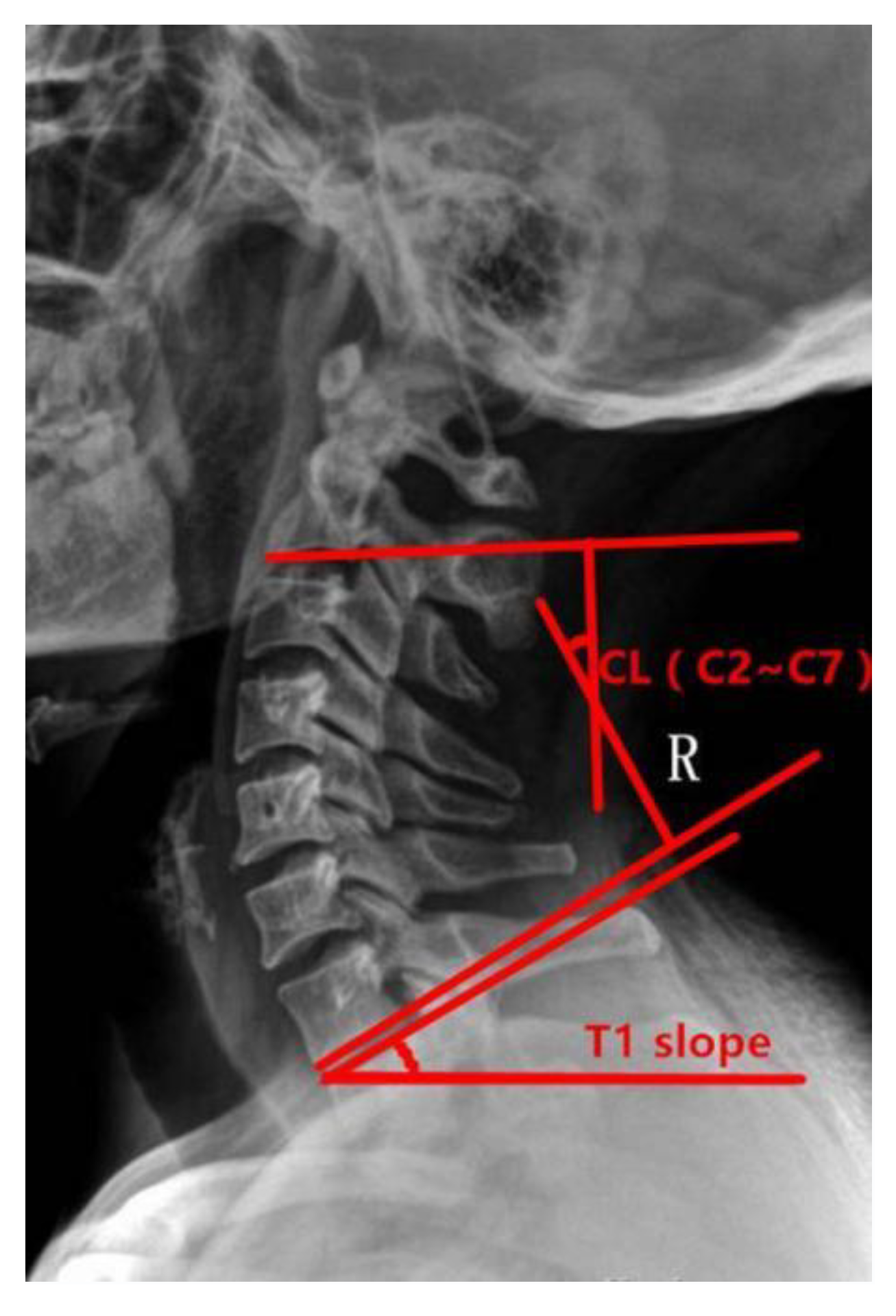 Brain Sciences Free Full Text Effect Of T1 Slope On Disappearance