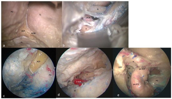 A New Perspective on the Cavernous Sinus as Seen through