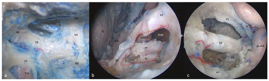 A New Perspective on the Cavernous Sinus as Seen through Multiple