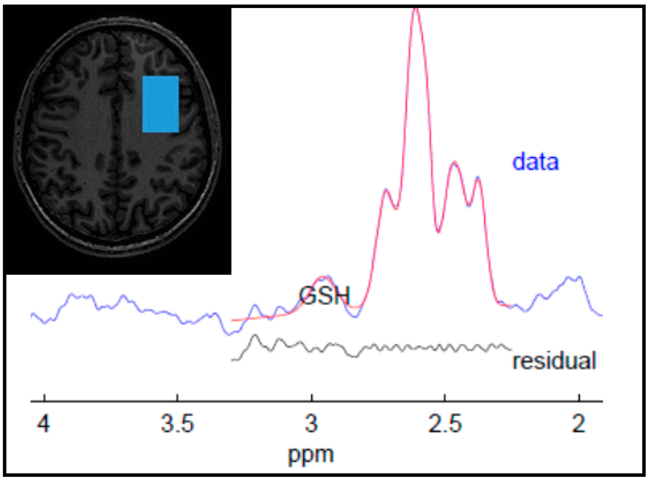 Prefrontal Glutathione Levels in Major Depressive Disorder Are Linked to a  Lack of Positive Affect