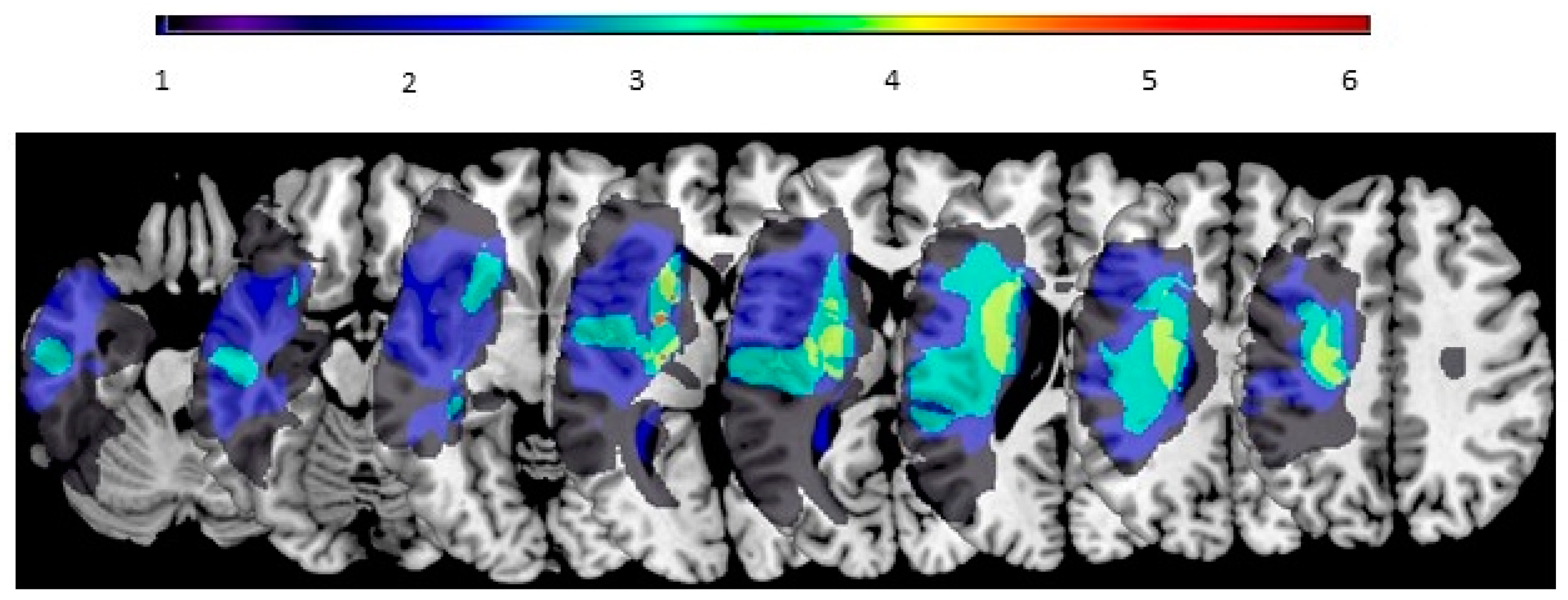 Cortical Sensorimotor Integration as a Neural Origin of Impaired Grip ...