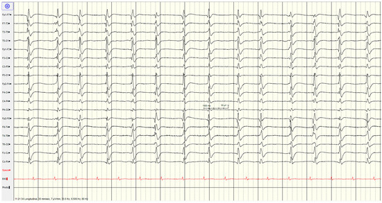 Electroencephalography (EEG) for Neurological