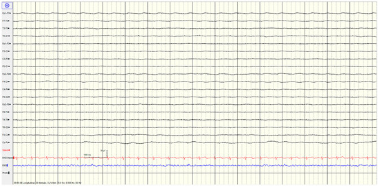Electroencephalography (EEG) for Neurological Prognostication in