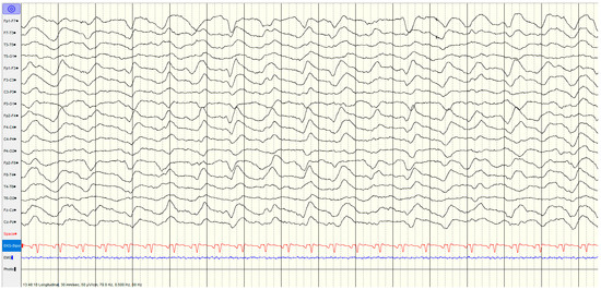Electroencephalography (EEG) for Neurological