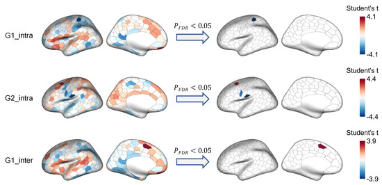 健康・医学 Effective Functional Progressions Altered Hemispheric Asymmetry of Functional Hierarchy in