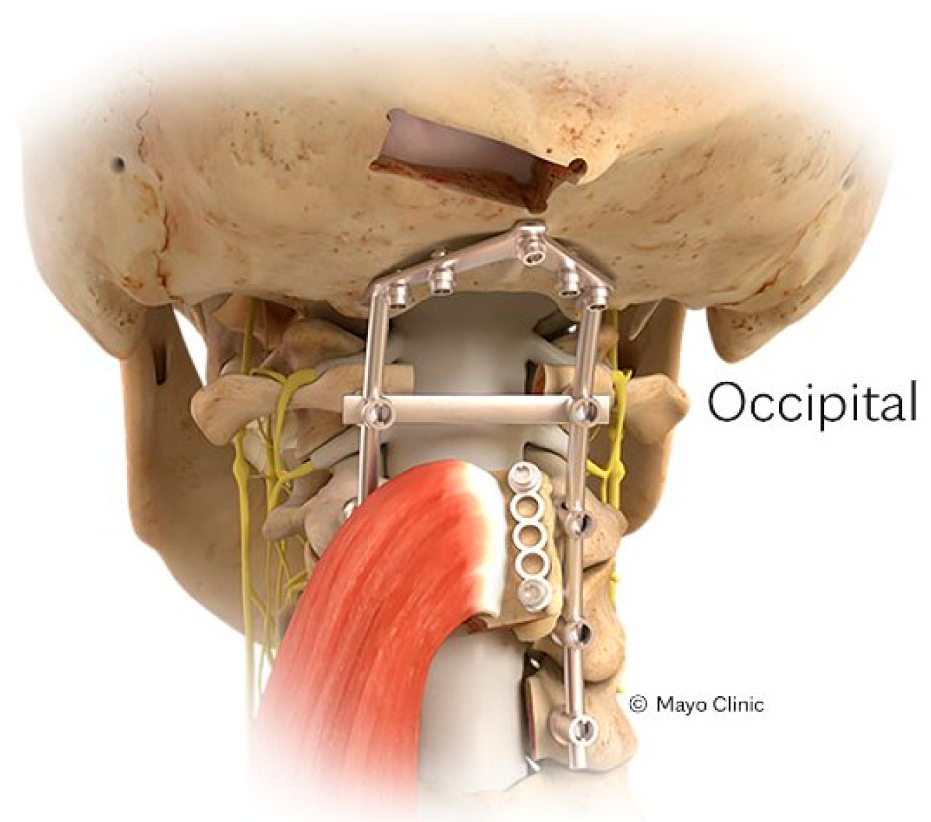 脊椎脊髄の手術 = Illustrated Surgery of Spine … 脊椎脊髄の手術 = Illustrated Surgery of Spine … Spine