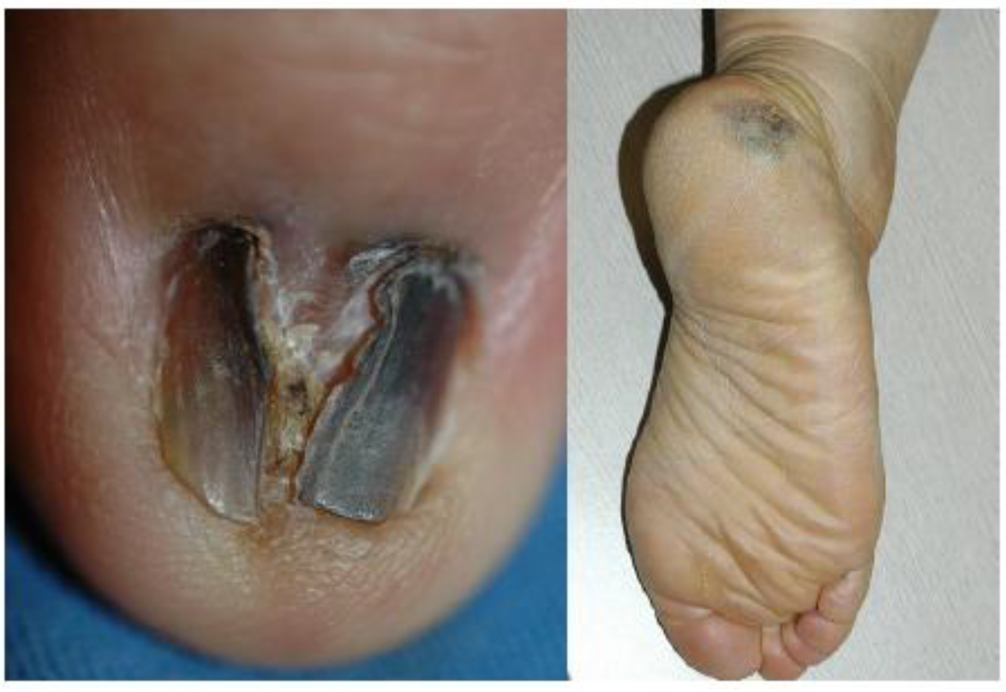 Malignant Melanoma Foot