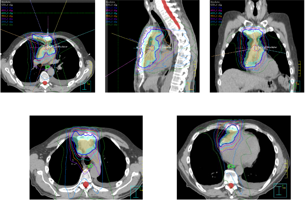 Cancers Free FullText Postoperative Radiation Therapy for Non