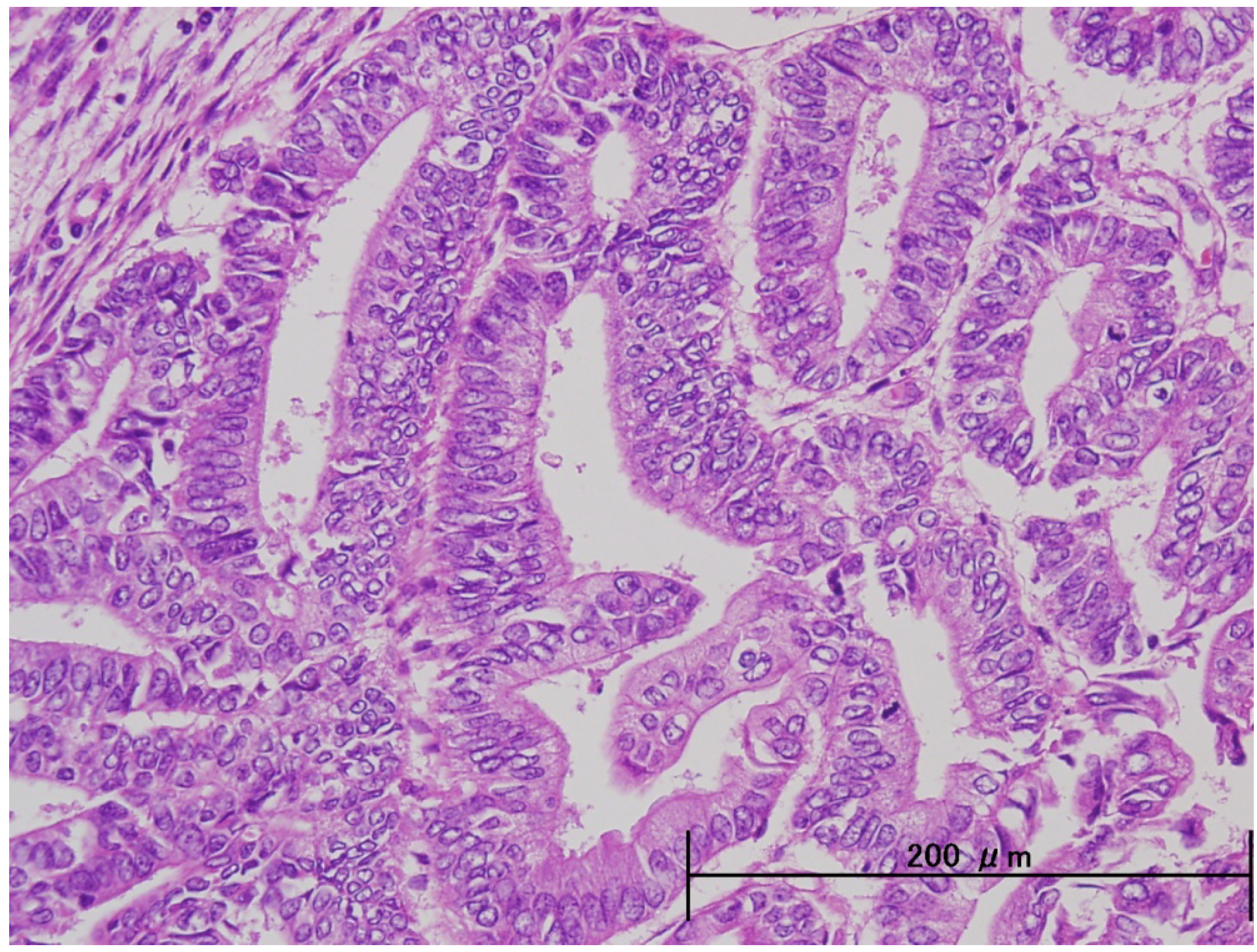 Cancers Free Full Text Endometrial Serous Carcinoma