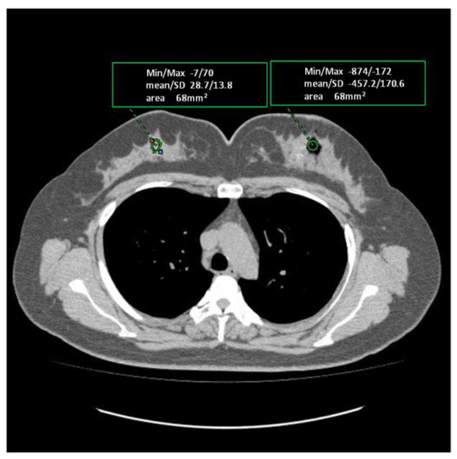 Computed Tomography Demonstration of the Production and