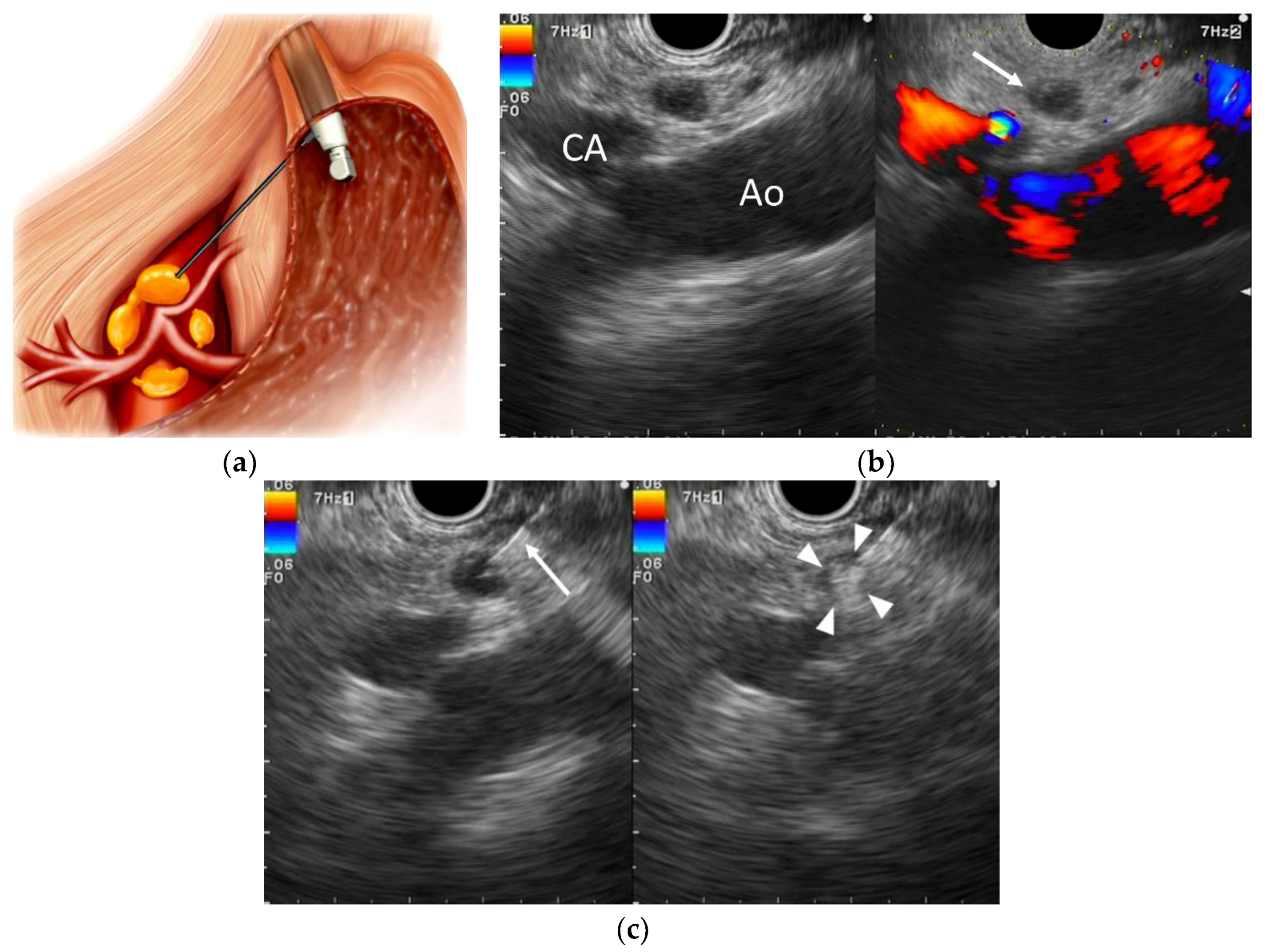 Cancers Free FullText Alleviating Pancreatic CancerAssociated