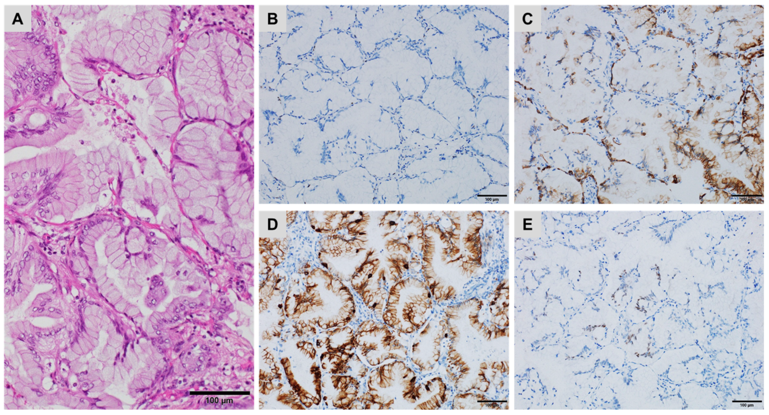 pleural mesothelioma without asbestos exposure