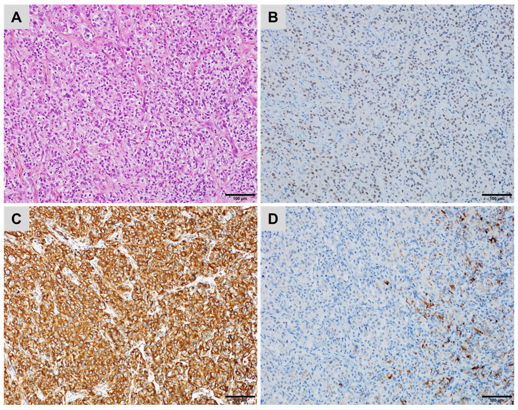 treatment for metastatic breast cancer to brain