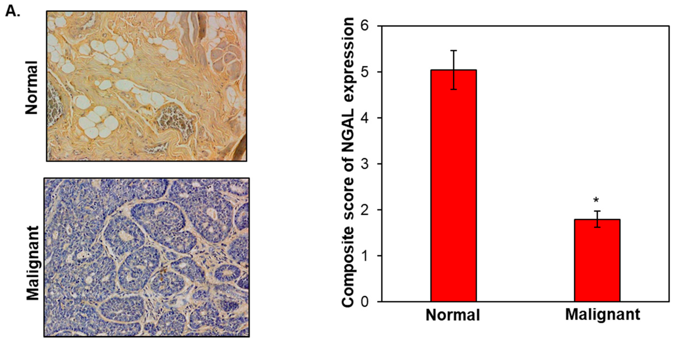 NGAL is Downregulated in Oral Squamous Cell Carcinoma and