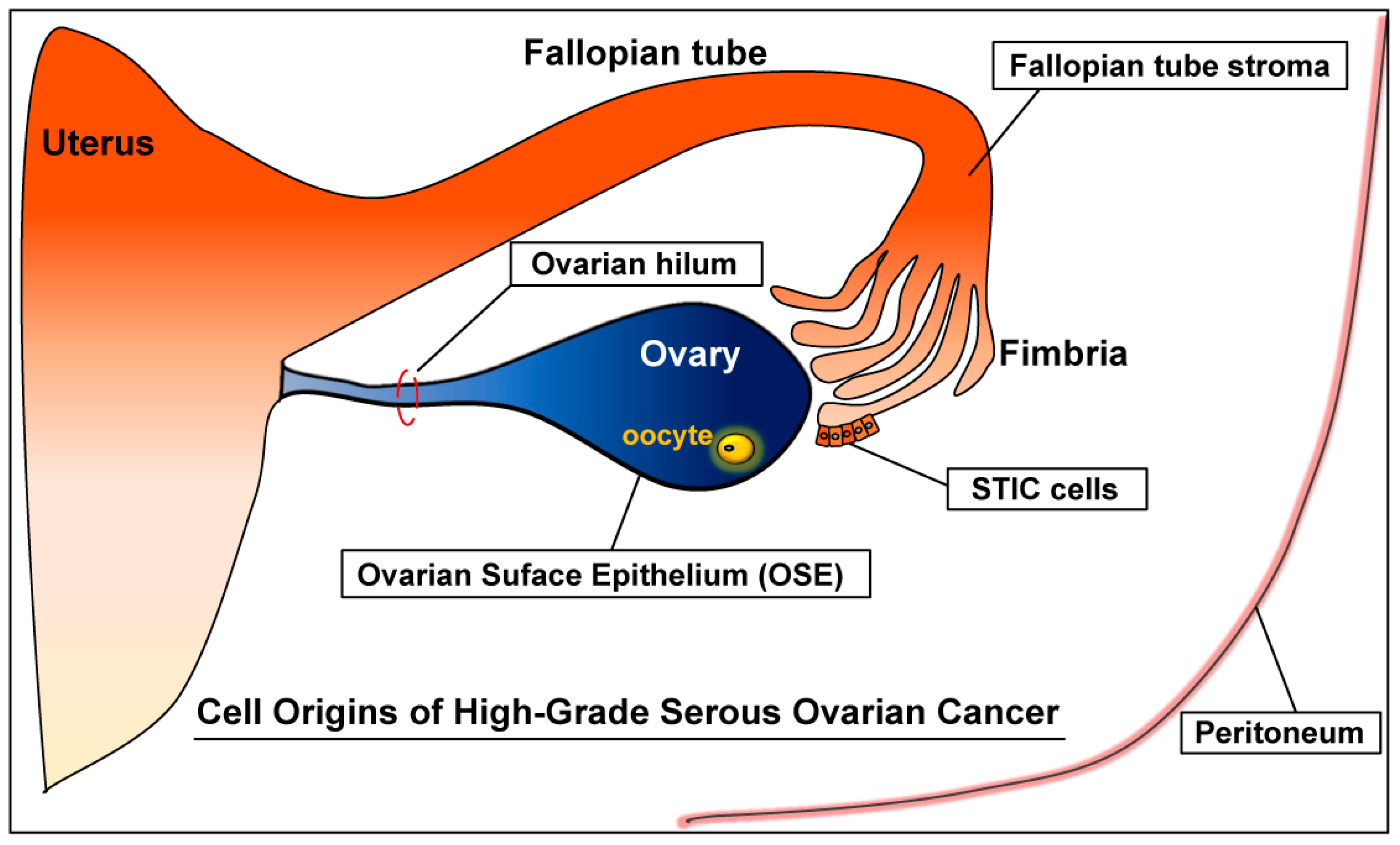 ovarian cancer epithelial origin cum să eliminați singur condiloamele