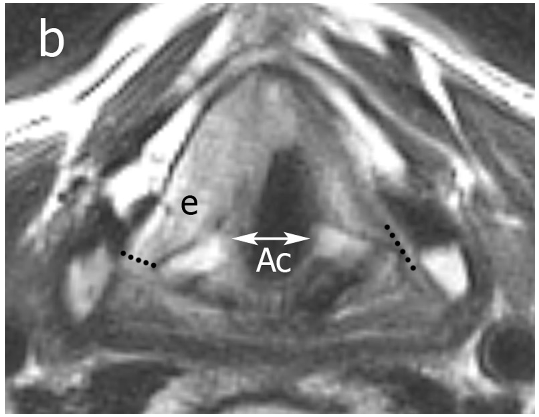 Cancers Free FullText Prediction of Posterior Paraglottic Space